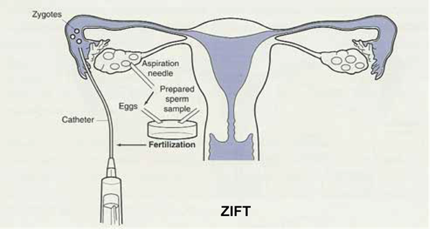 Gamete Intrafallopian Transfer (GIFT) & Zygote Intrafallopian Transfer (ZIFT)